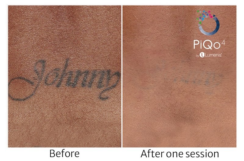 Before and after PiQo4's Tattoo Removal treatment
