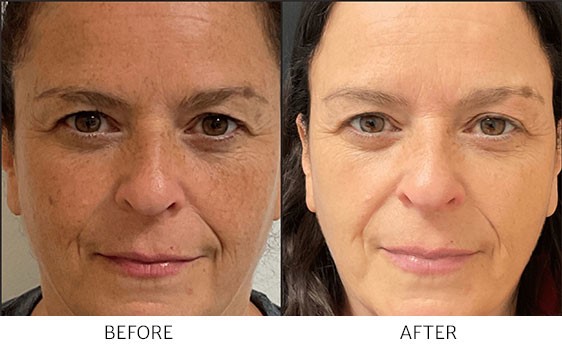 Before and After IPL Photofacial treatment