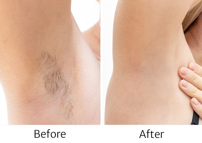 Before and after laser hair removal