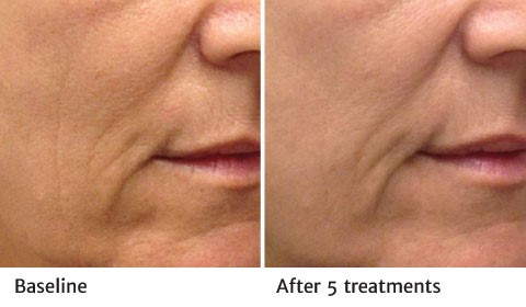 Before and after RF Microneedling treatment