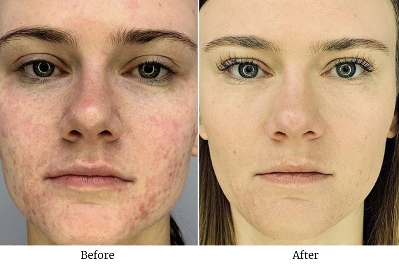 Before and after platelet-rich fibrin treatment