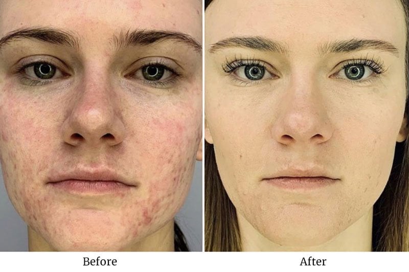 Before and after RF Microneedling with Platelet-Rich Fibrin treatment