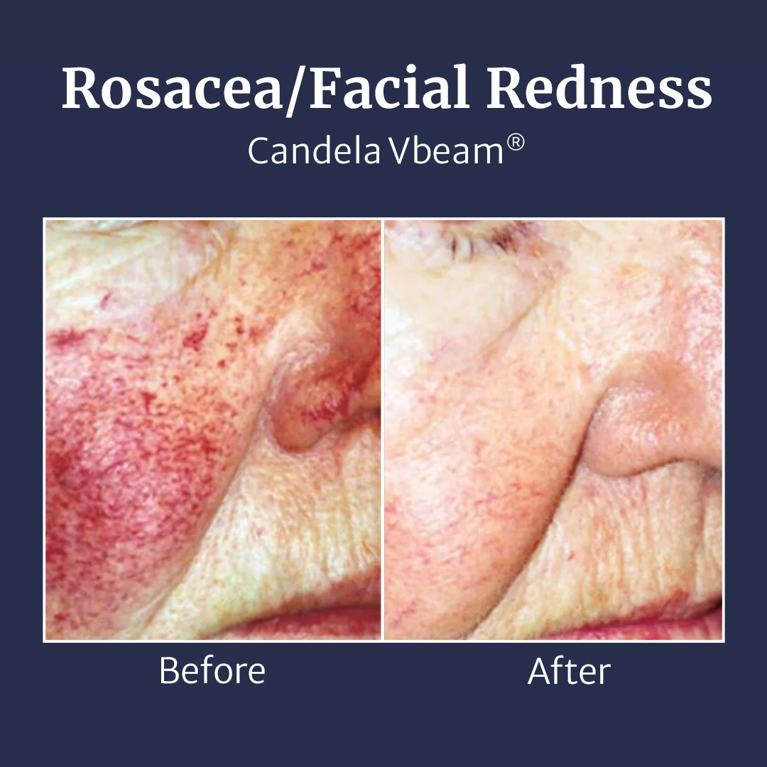 Rosacea/Facial Redness Candela Vbeam Before and After