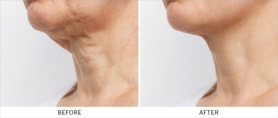 Before and after images of great NuEra&reg; Skin Tightening results in the neck area