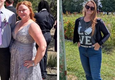 Before and after image of an ARC Bariatric Surgery patient