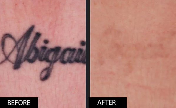 Before and after PicoWay Laser Treatment on tattoo