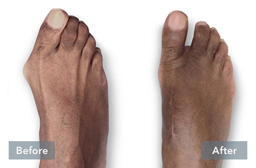 Before and after Lapiplasty 3D bunion correction