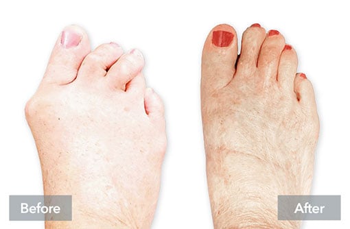 Before and after Lapiplasty 3D bunion correction