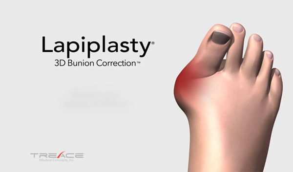 Lapiplasty 3D Bunion Correction Video