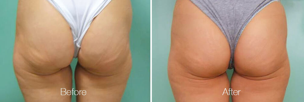 Before and after NuEra skin tightening treatment on the buttocks area