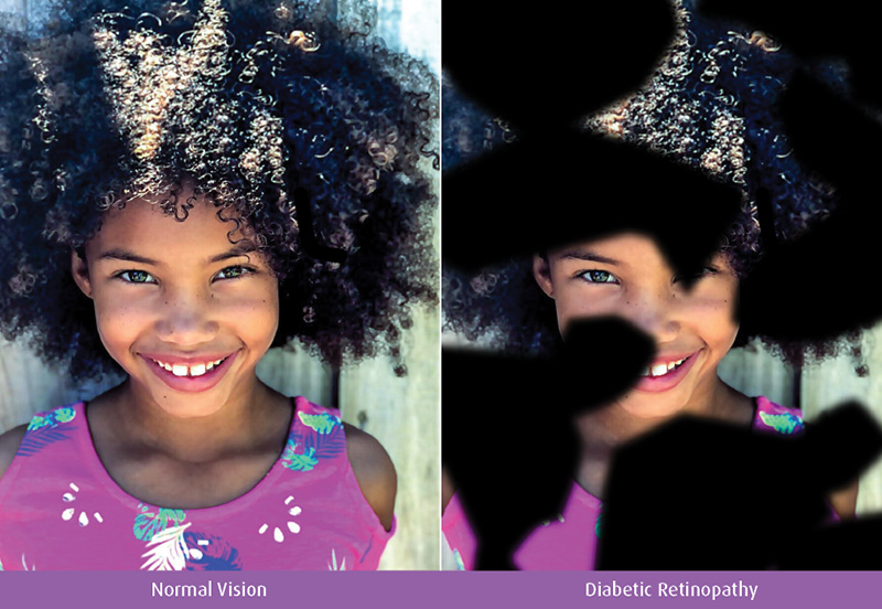 Example of normal vision vs diabetic retinopathy