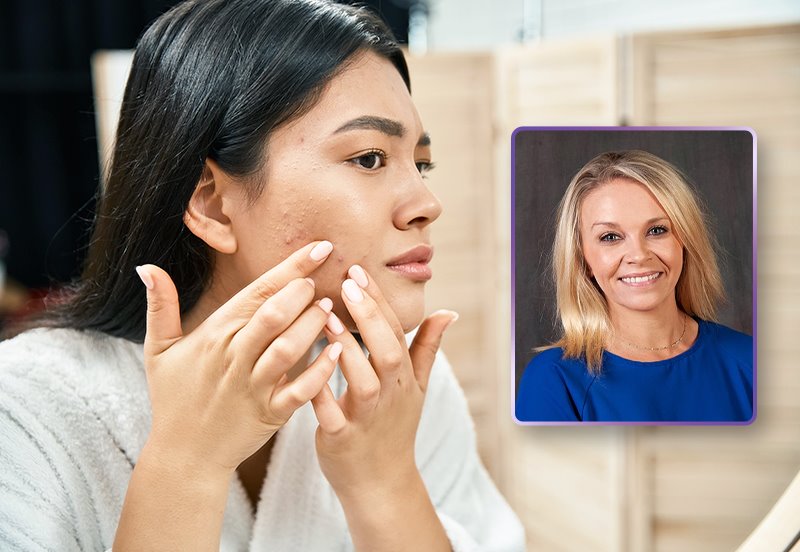 Woman examining her acne breakout on her face while looking in a bathroom mirror, and an image of Marci J. Christensen, CMA, CLT, BSHS, OLINO Medical Aesthetics team member