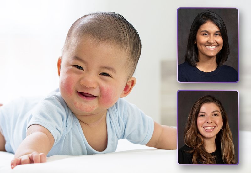 Baby boy with rashes on his cheeks smiling during tummy time, an image of Ishita Ghosh, MD, Pediatrician at ARC, and an image of Heather C. Lenz, PA-C, Dermatology Advanced Practice Clinician at ARC