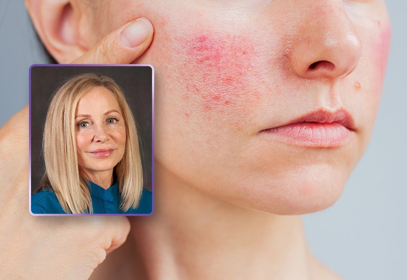 Image of a person with facial redness in the cheeks and an image of Melissa Petterson-Hill, RN, OLINO Medical Aesthetics team member