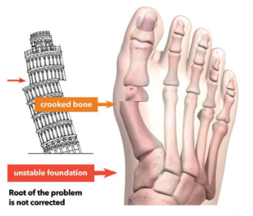 Explanation of Traditional bunion surgery