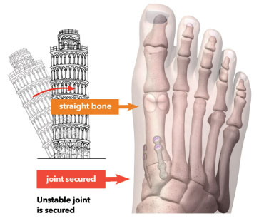 Explanation of Lapiplasty 3D Bunion Correction